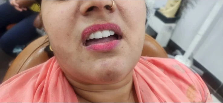 Implant treatment — alternate view